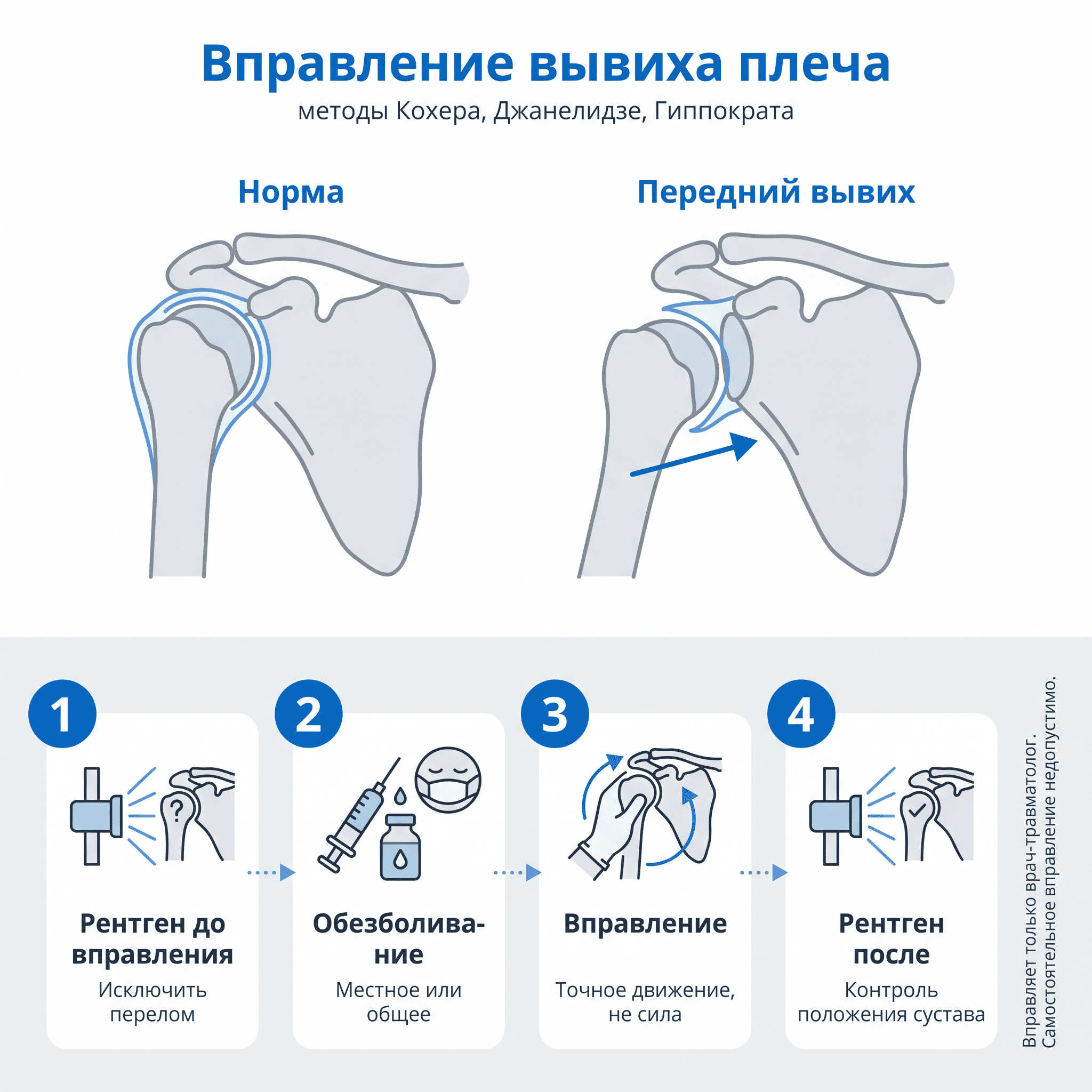 Способы вправления вывиха плеча